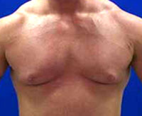 male breast cancer