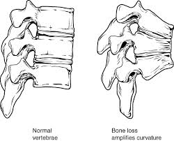 osteoporosis