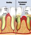 smoking can cause gum disease