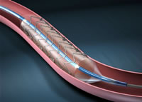 Drug Eluting Stent approved for clogged arteries in the leg
