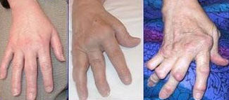 rheumatoid arthritis symptoms