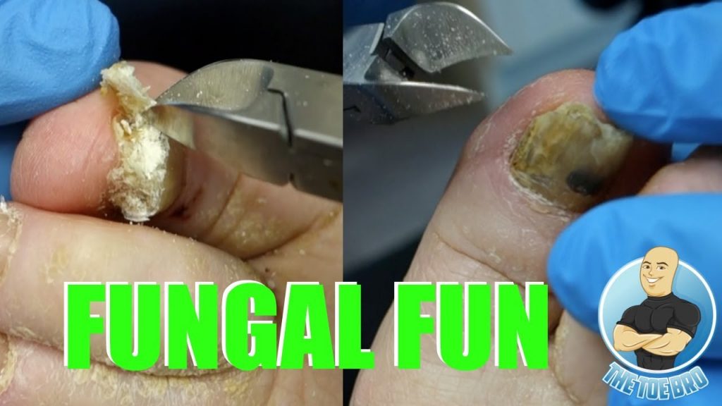 EXTREME BAD NAIL FUNGUS TREATMENT 1 FOOT HEALTH MONTH 2018 17